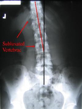 X-ray Showing Subluxations (Misalignments) of Lumbar Vertebrae in the Lower Back