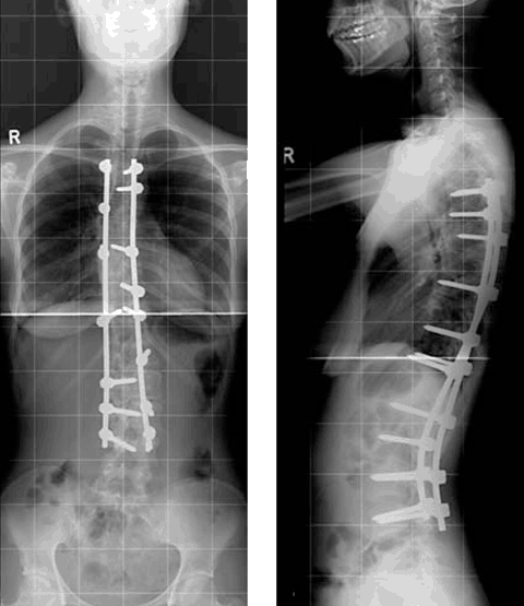 ScoliosisSurgery