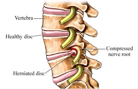 Herniated discs are treated safely and effectively with chiropractic care