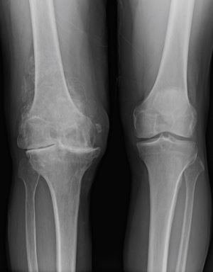 misaligned knee joint