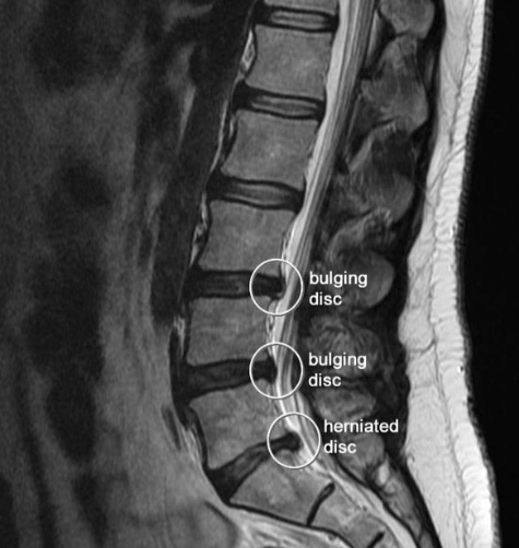 herniated mri pain causes bulging showing discs know shot spine pressure predisposing needs everyone screen abdominal